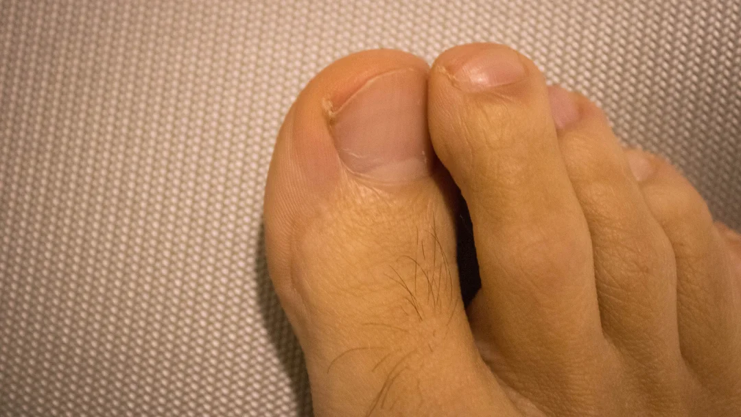 L_ongle incarné _ causes, prévention et soins efficaces