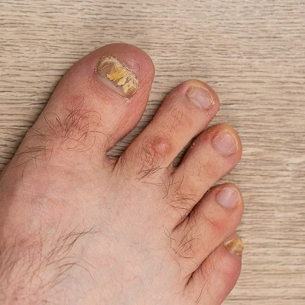 Un gros plan sur un orteil présentant une mycose de l'ongle, montrant des décolorations et des irrégularités.