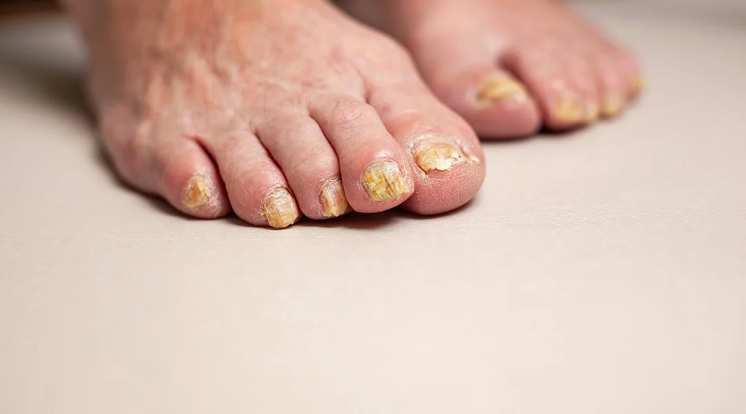 A close-up of yellow-painted toenails, highlighting the vibrant color of the nail polish.